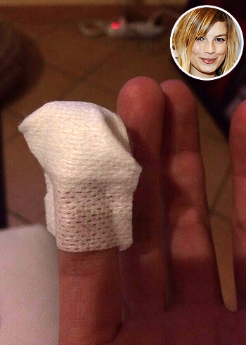 Emma, polpastrello riattaccato con la colla