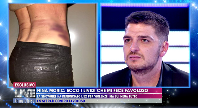 La foto di Nina Moric con un enorme livido sul fianco, che secondo Favoloso le sarebbe stato causato da sua madre, ma secondo la showgirl sarebbe frutto di una violenza proprio del 32enne