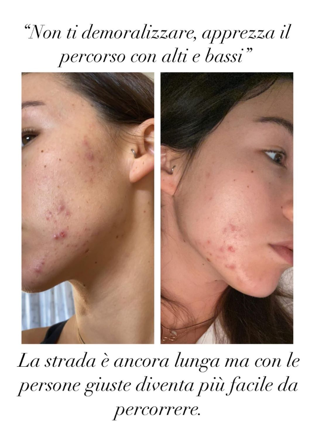 Aurora Ramazzotti, ancora problemi di acne: mostra l'evoluzione della pelle