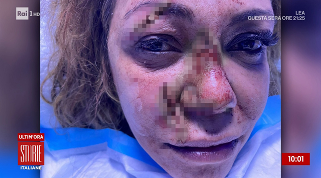 Linda Batista picchiata a Dubai, 45 punti di sutura al viso: ecco cos'è successo