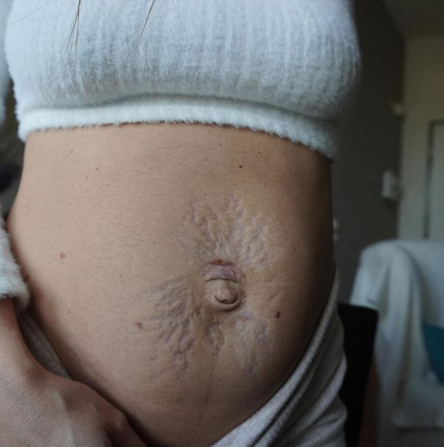 Gracia De Torres mostra la pancia dopo il parto gemellare: 'E' diventata una mappa del tesoro, un terrore'