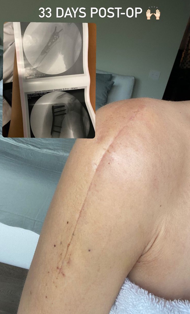 La moglie di Francesco Facchinetti mostra la cicatrice 33 giorni dopo l'operazione alla spalla