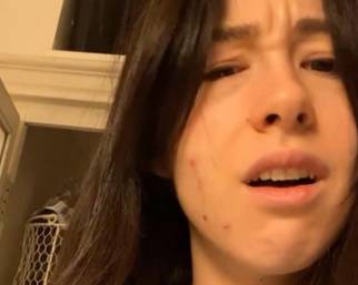 Aurora Ramazzotti, le spunta brufolo prima dello shooting